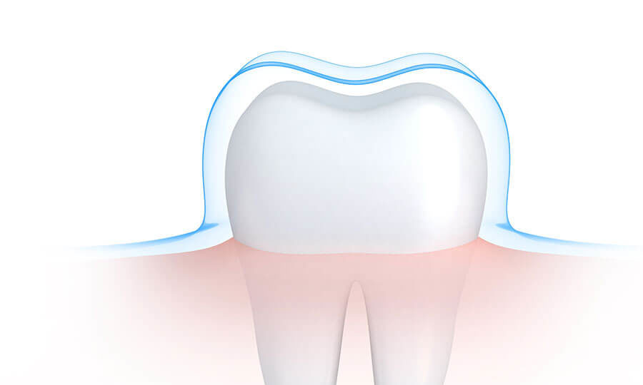 Valutazione In Vitro Della Risposta Di Cellule Infiammatorie A Viti Da Impianto Con Differenti Superfici Implantari