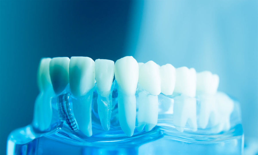 Impianti Dentali E Fattori Estetici Del Sorriso