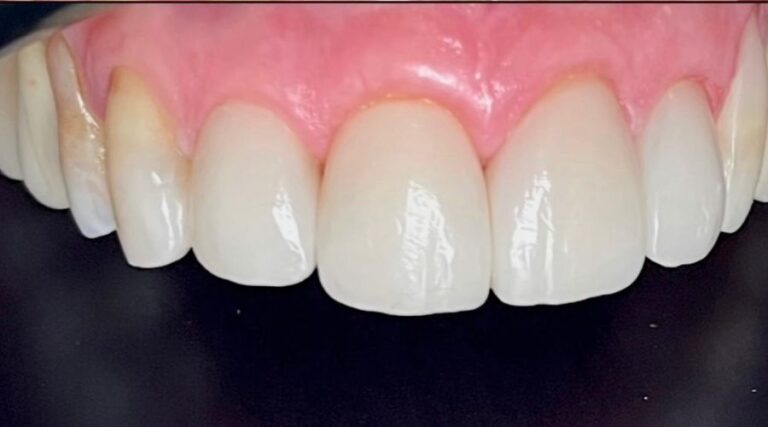 Faccette dentali - Dopo 1