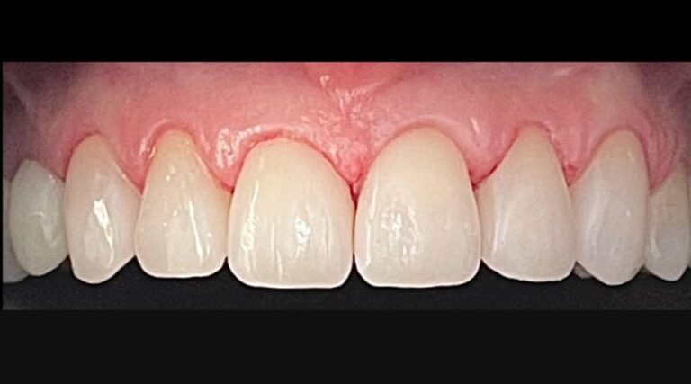 Faccette dentali - Dopo 2