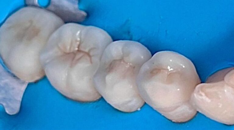 Faccette dentali - Dopo 3
