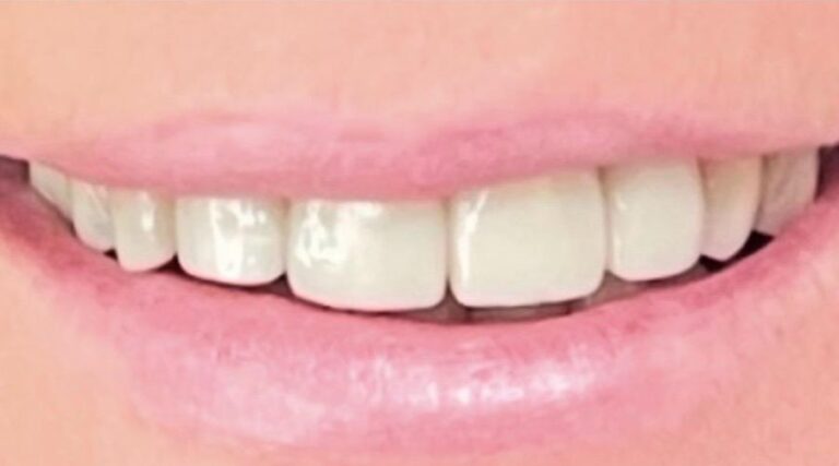 Faccette dentali - Dopo 4