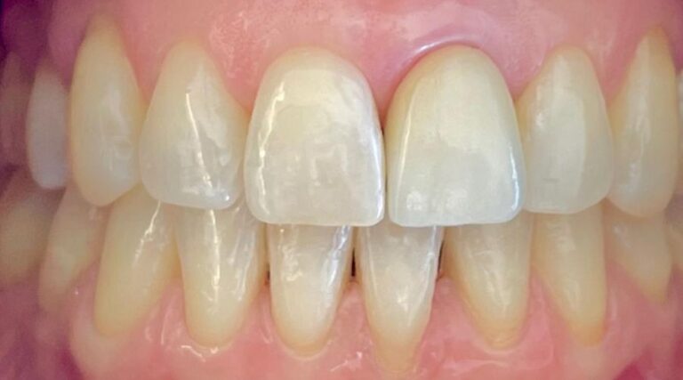 Faccette dentali - Dopo 5