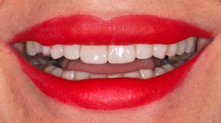 Faccette dentali - Dopo 6