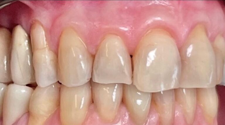Faccette dentali - Prima 1 - Casi Prima e Dopo
