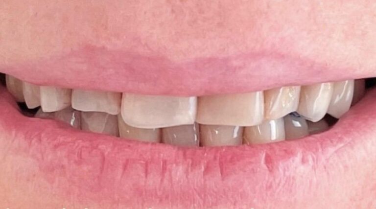 Faccette dentali - Prima 4