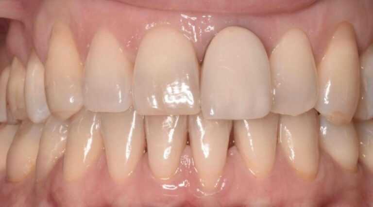 Faccette dentali - Prima 5