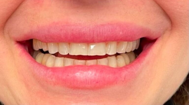 Faccette dentali - Prima 6