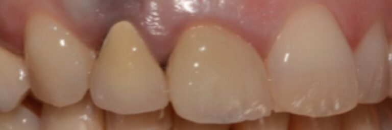 Impianto dentale - Prima (3)