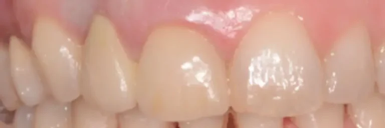 Impianto dentale - Dopo (3)